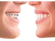 Orthodontic Treatment with Dr. William Ledoux