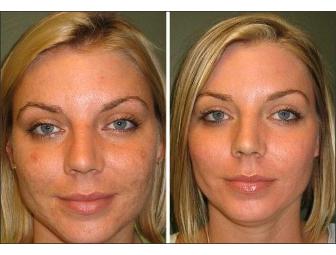 One Free Consultation + One Chemical Peel from CPW Vein & Aesthetic Center