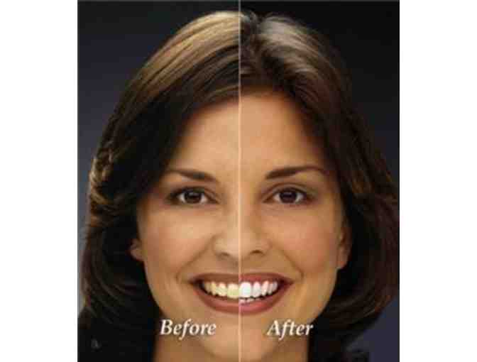 Zoom Whitening Treatment from Healthy Tooth Dental