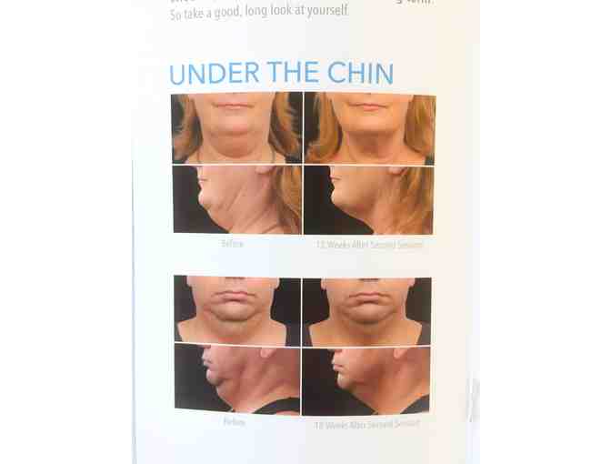 Coolsculpting Non Surgical Fat Melting