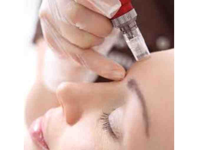 Telo Labs - RF Microneedling ($900 value)