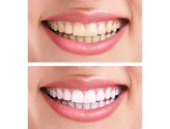 Teeth Whitening