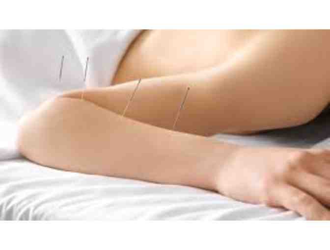 Circle Balance Initial Acupuncture session for new patient - GC $150