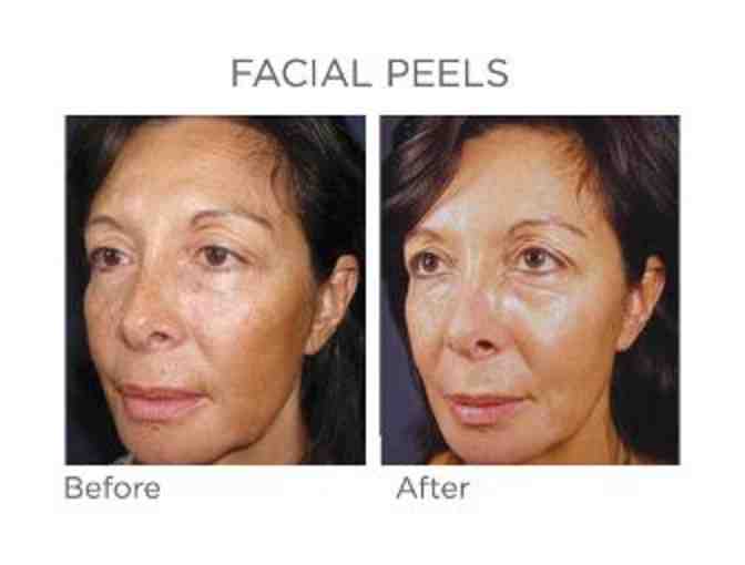 ! Chemical Peel Package with DR. LANCE BROWN