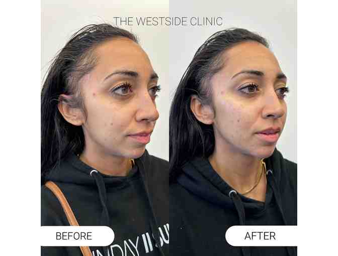 The Westside Clinic - 60 Units of Botox