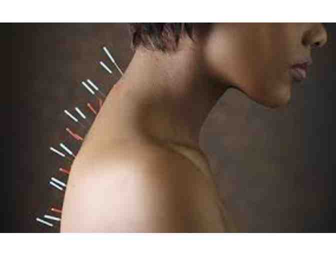 One Acupuncture session with Lynda Danzig